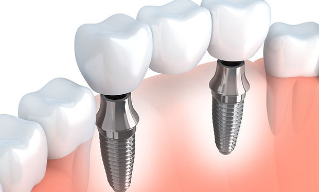 puente implantes.jpg