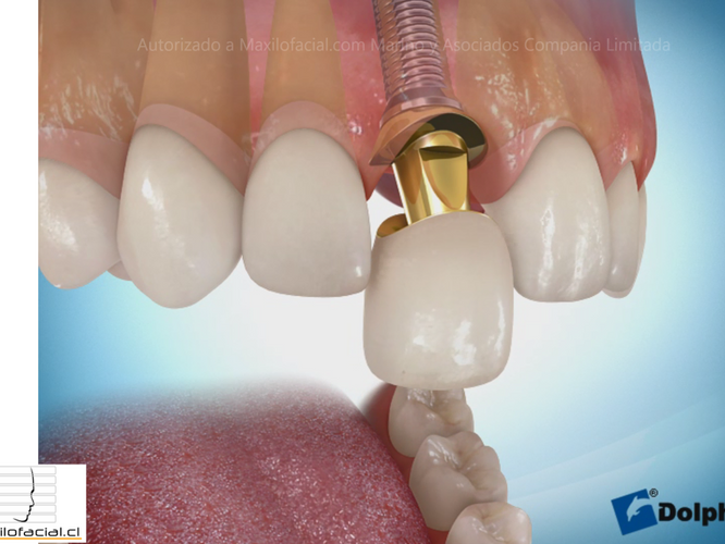 Cuidados en una cirugía de implantes