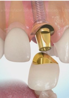 implantedental.jpg