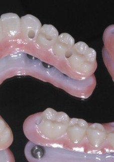 puentes-de-implantes-edentulo-1.jpg