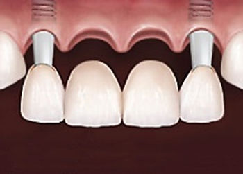 puente-dental-de-cuatro-piezas.jpg