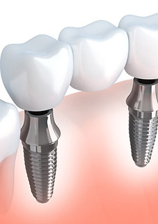 puente implantes.jpg