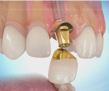 implantedental.jpg