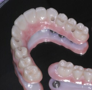 puentes-de-implantes-edentulo-1.jpg