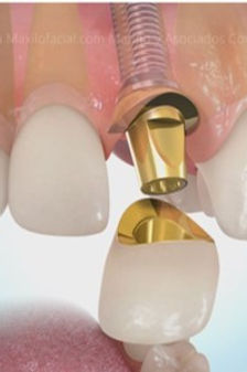implantedental.jpg