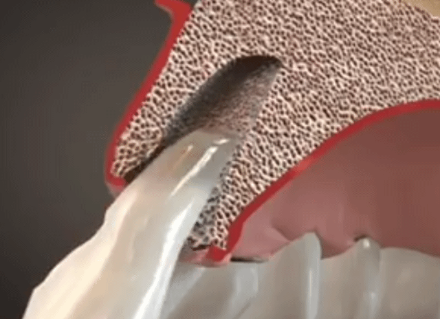 Implante dental inmediato
